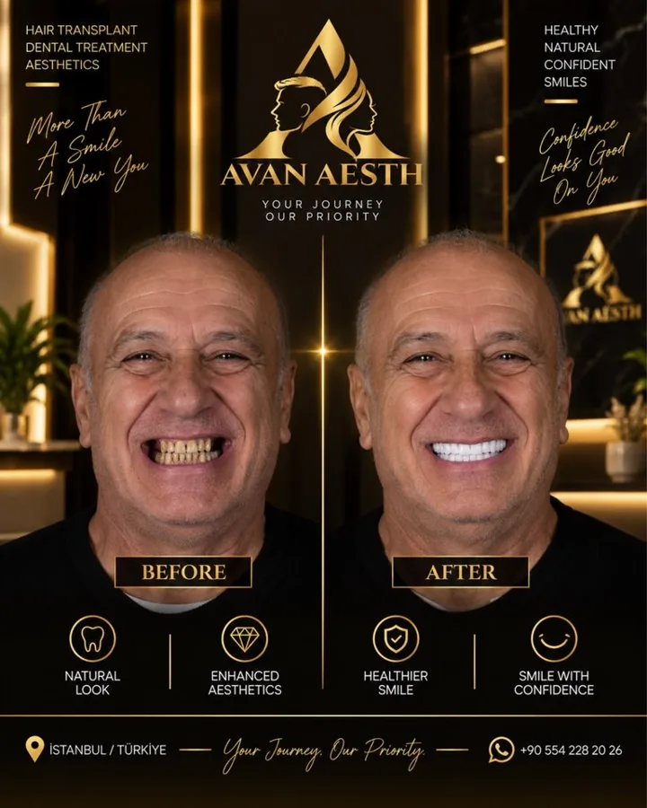Avan Aesth dental treatment before and after