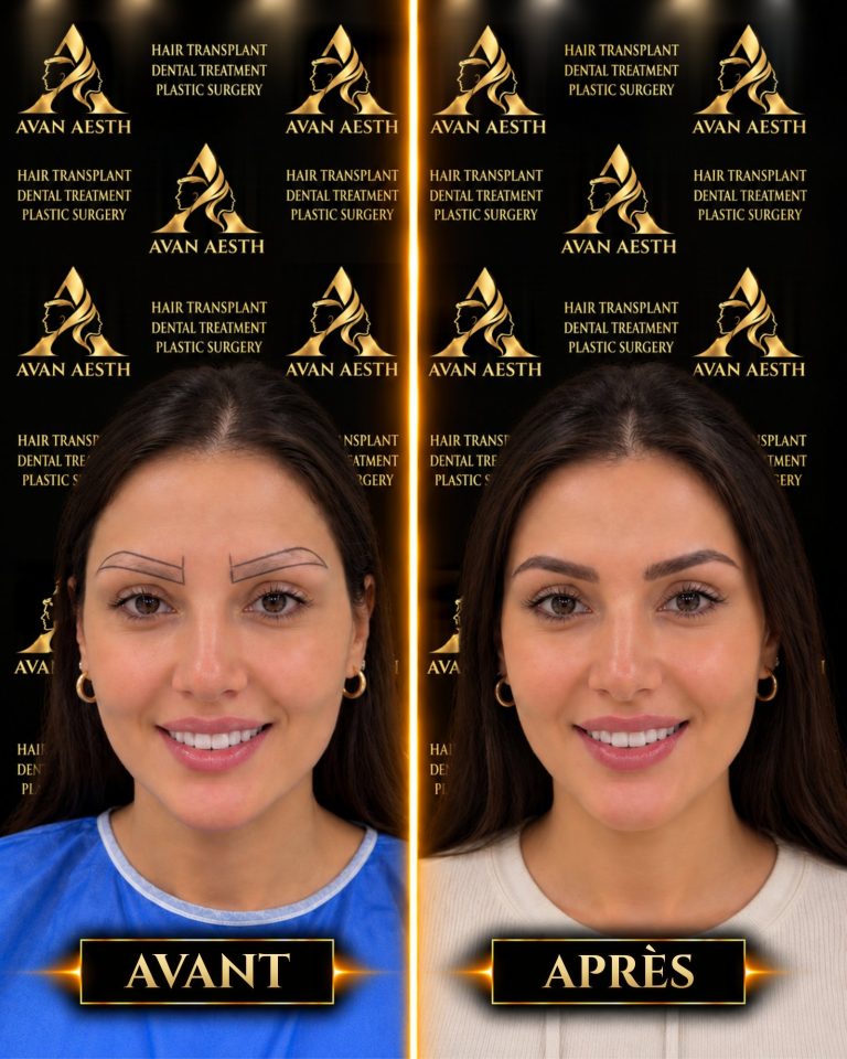 Greffe de sourcils avant et après – image 1
