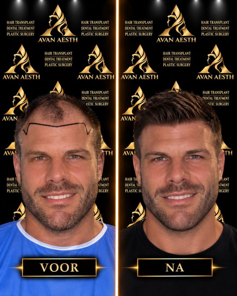 Haartransplantatie voor en na – voorbeeld 10