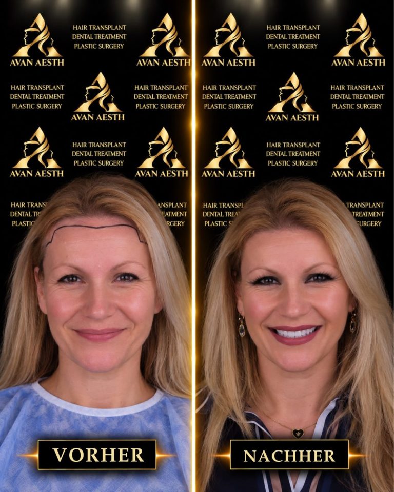 Haartransplantation vorher und nachher – Beispiel 9