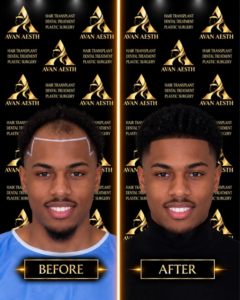Hair transplant before and after – example 7