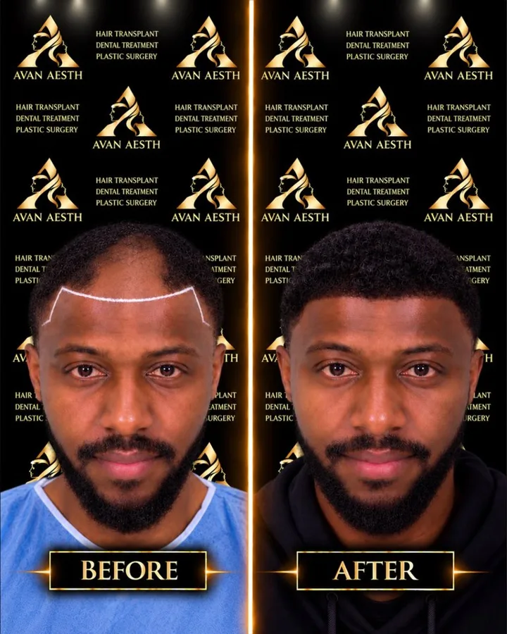 Avan Aesth hair transplant before and after