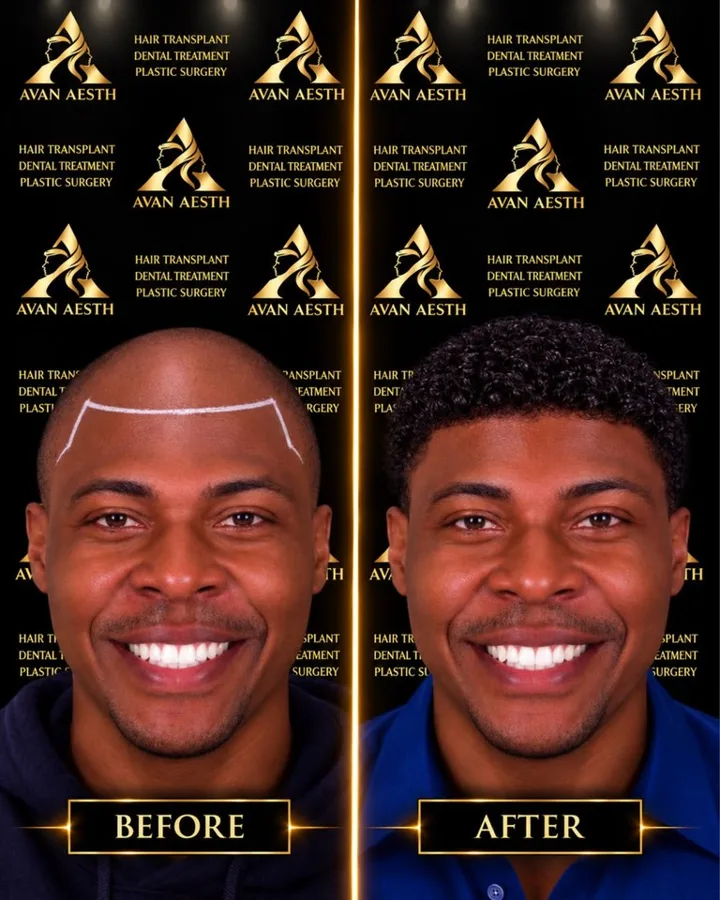 Avan Aesth hair transplant before and after