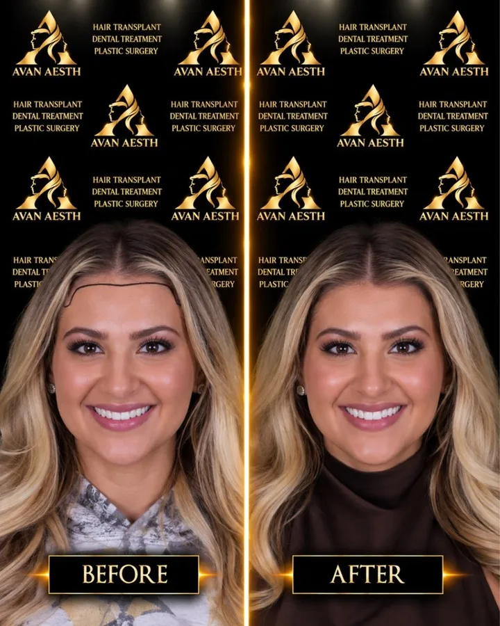 Avan Aesth hair transplant before and after