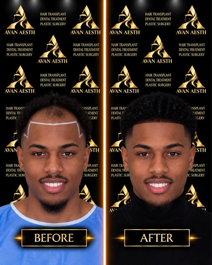 Avan Aesth hair transplant before and after
