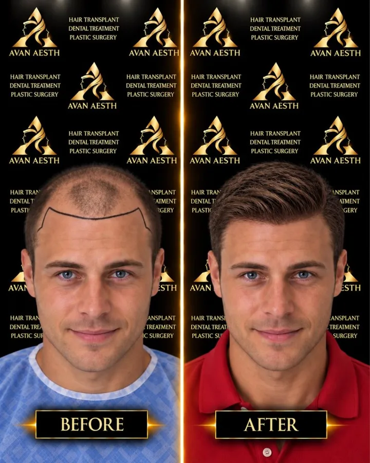 Avan Aesth hair transplant before and after