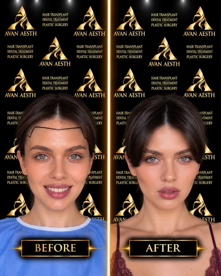 Avan Aesth hair transplant before and after