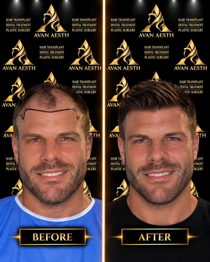 Avan Aesth hair transplant before and after