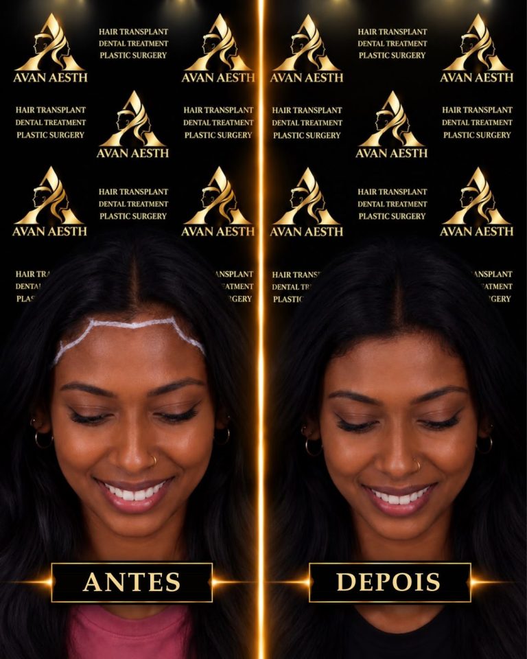 Transplante capilar antes e depois – imagem 5