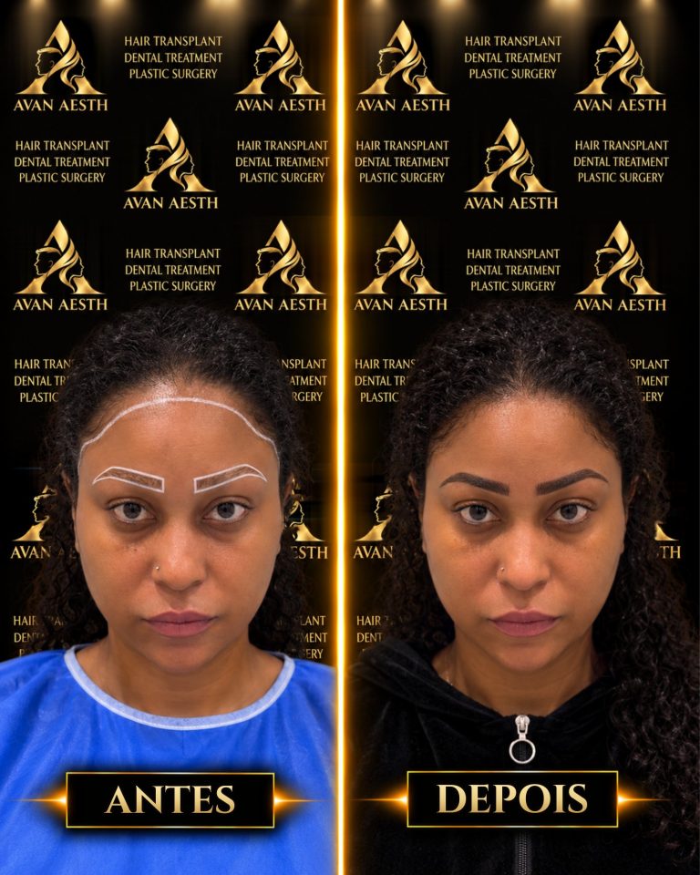 Transplante de sobrancelhas antes e depois – imagem 2