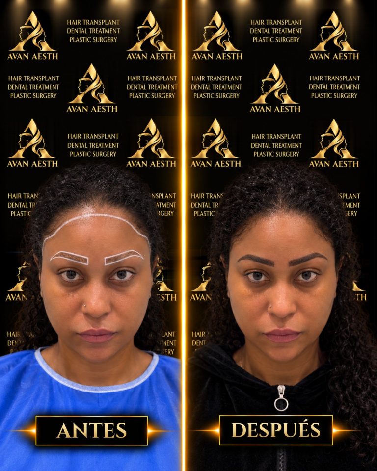 Trasplante de cejas antes y después – imagen 2