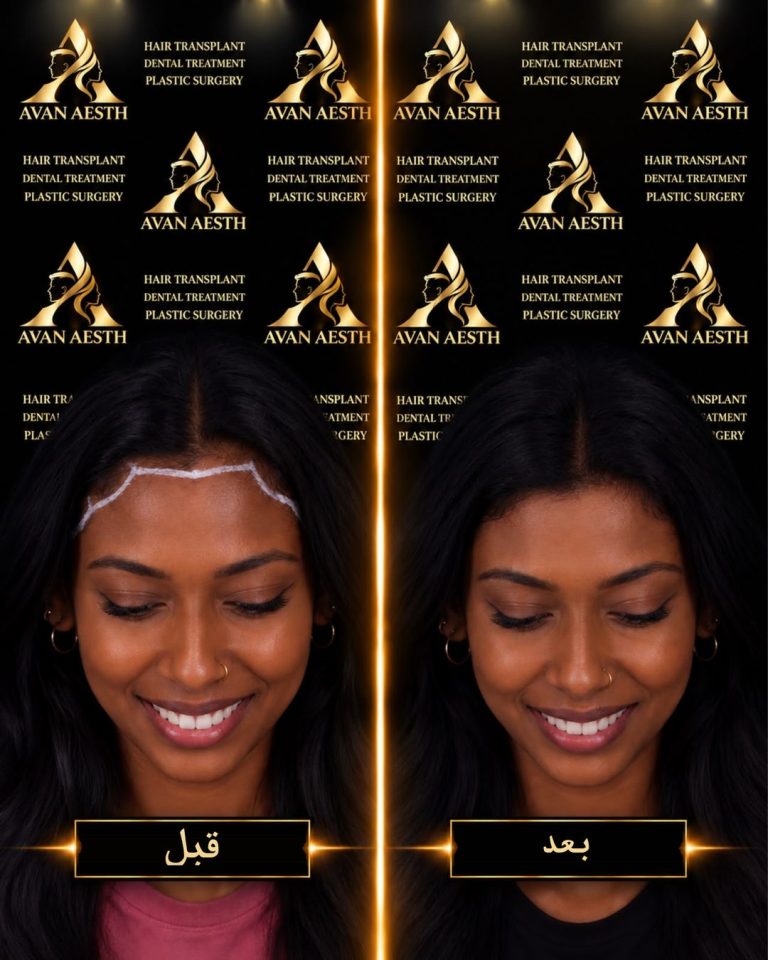 زراعة الشعر قبل وبعد – صورة 5