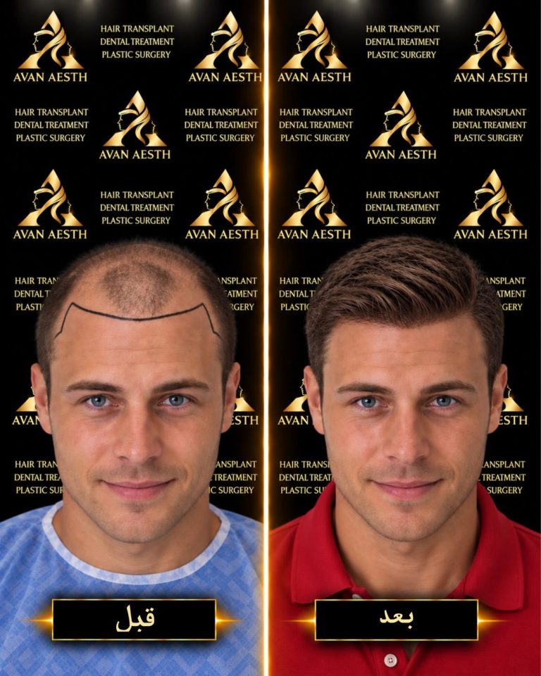 زراعة الشعر قبل وبعد – صورة 8